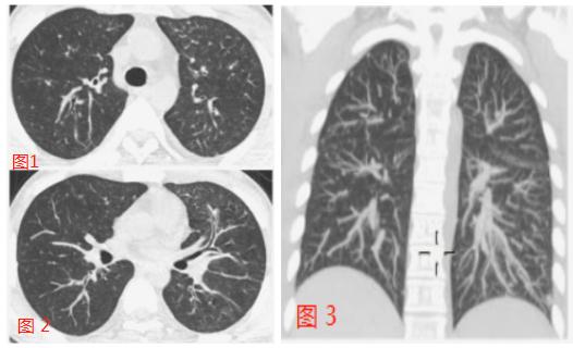 得甲流变病毒性肺炎，深度解析与应对策略_具体执行和落实