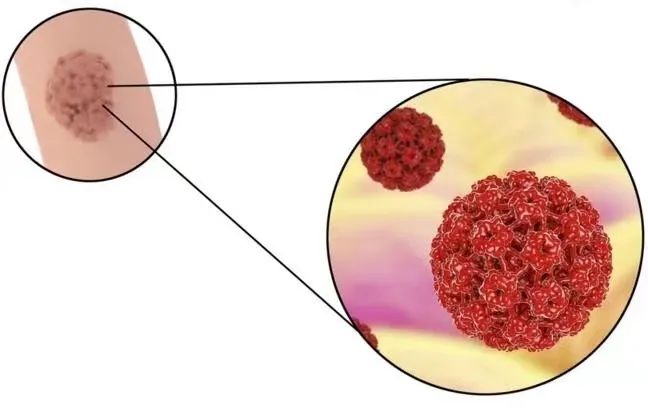 身上五种小疙瘩可能与HPV感染有关，了解、预防与应对措施_全面解答解释落实
