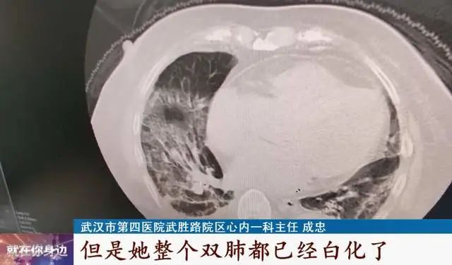 男子感染流感短短几天出现白肺，警惕流感并发症的严重性_具体执行和落实