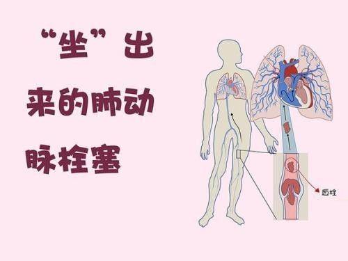 警惕久坐超两小时血栓风险增加，预防胜于治疗_贯彻落实