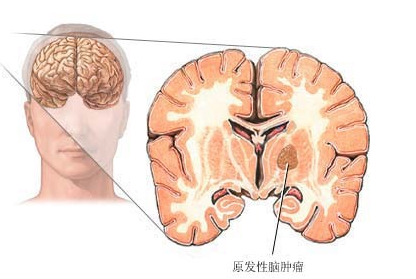 陪诊被医生看出脑瘤，深度解读与健康警示_全新精选解释落实