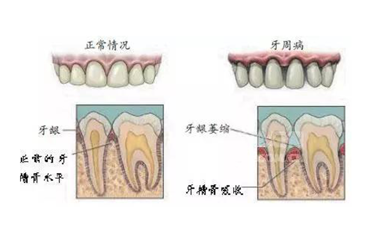 牙周病患者脑卒中可能性大增，预防与关注的重要性_落实执行