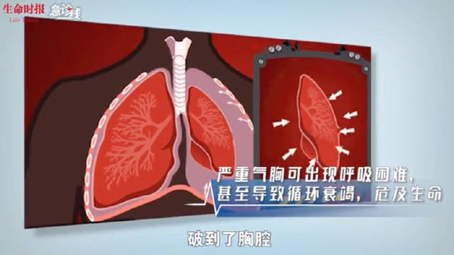 揭秘气胸，不为人知的呼吸危机！_反馈分析和检讨