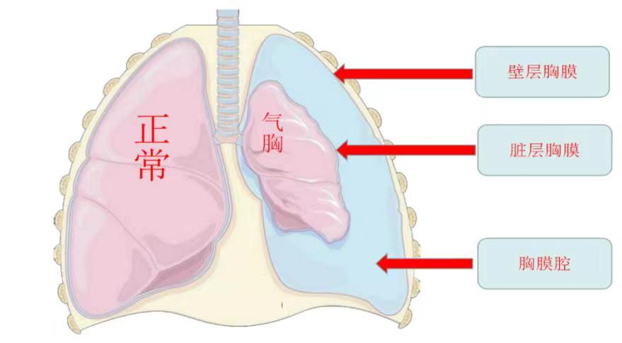 揭秘爆肺真相，症状、成因与防治方法，你真的了解吗？_精密解答