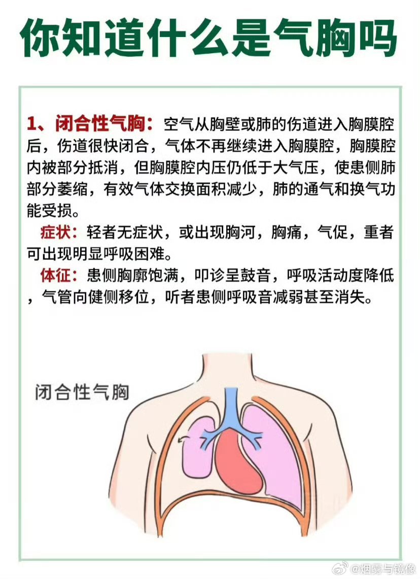 揭秘！高瘦男性气胸频发背后的原因，令人震惊！_明确落实