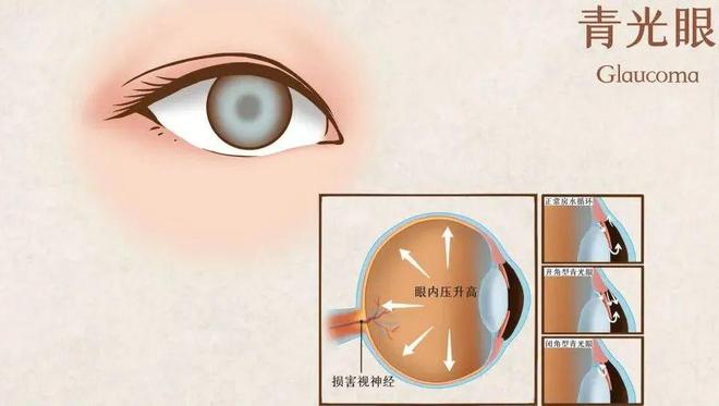 关于世界青光眼日，_全面解答解释落实